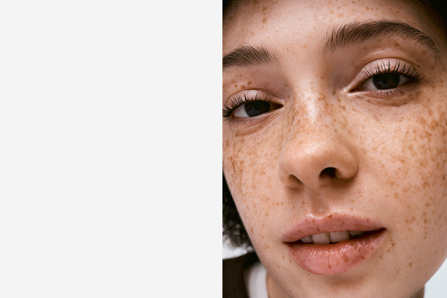 Acne